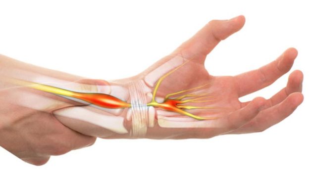 Hội chứng ống cổ tay là tình trạng dây thần kinh trong ống cổ tay bị chèn ép, gây đau tay.